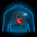 Artificial,Cardiac,Pacemaker,Location.,Realistic,Heart,And,Pacemaker,Into,Blue